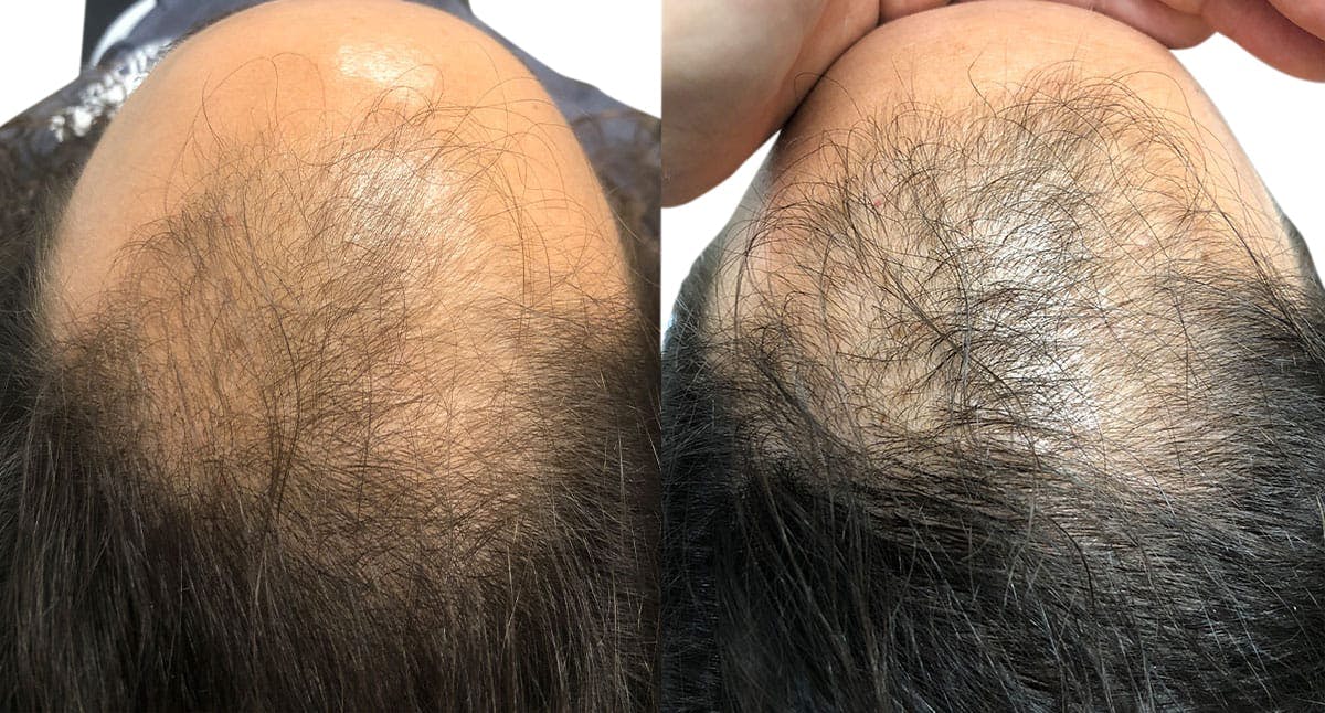 FUE Hair Transplant Before & After Gallery - Patient 399808 - Image 1