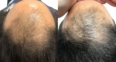 FUE Hair Transplant Before & After Gallery - Patient 399808 - Image 1