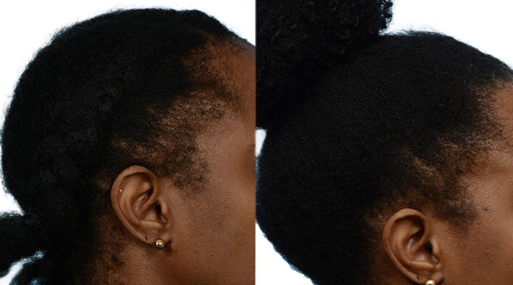 Hair Restoration  Before & After Gallery - Patient 311678 - Image 1