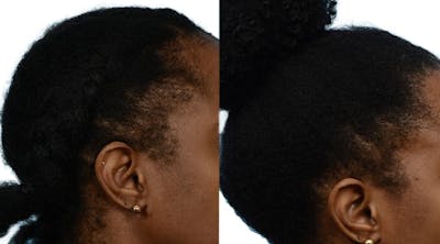Female Hair Restoration Before & After Gallery - Patient 123169 - Image 1