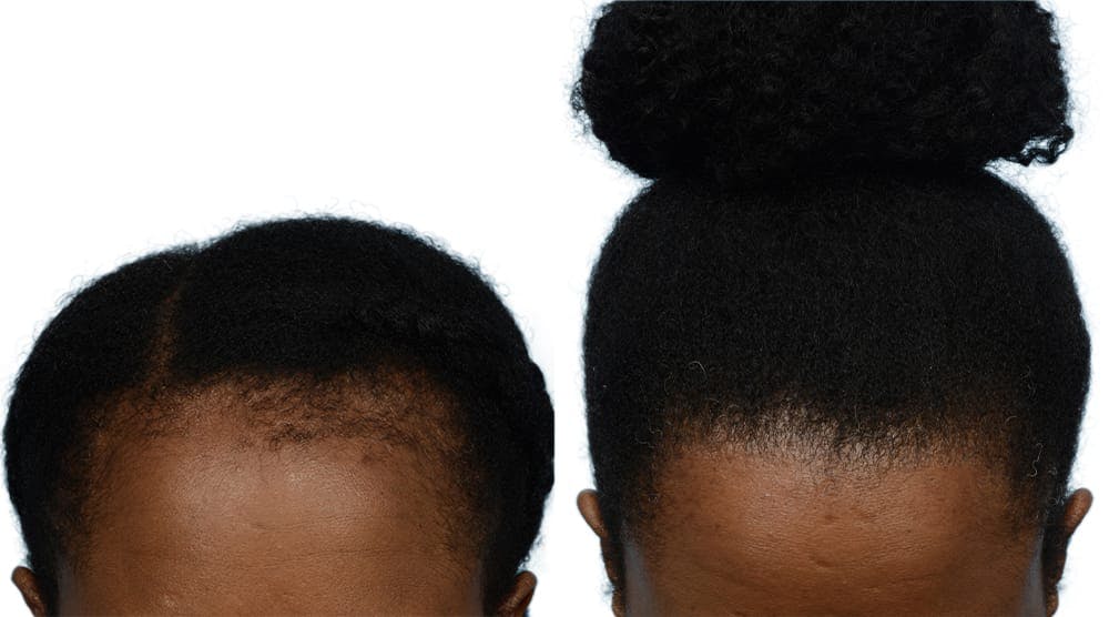 Hair Restoration  Before & After Gallery - Patient 311678 - Image 2