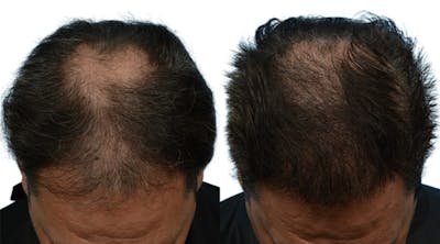FUE Hair Transplant Before & After Gallery - Patient 415156 - Image 1