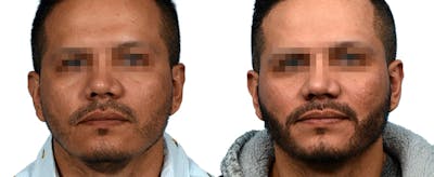 Facial Hair Transplant Before & After Gallery - Patient 148502 - Image 1
