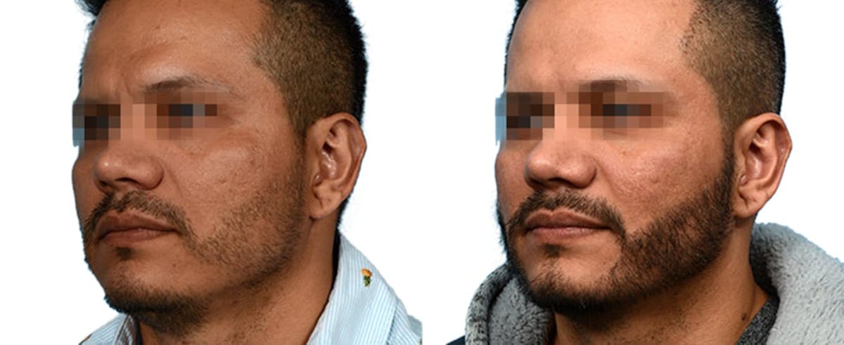 Facial Hair Transplant Before & After Gallery - Patient 148502 - Image 2