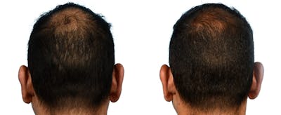 Hair Restoration Before & After Gallery - Patient 114079 - Image 1