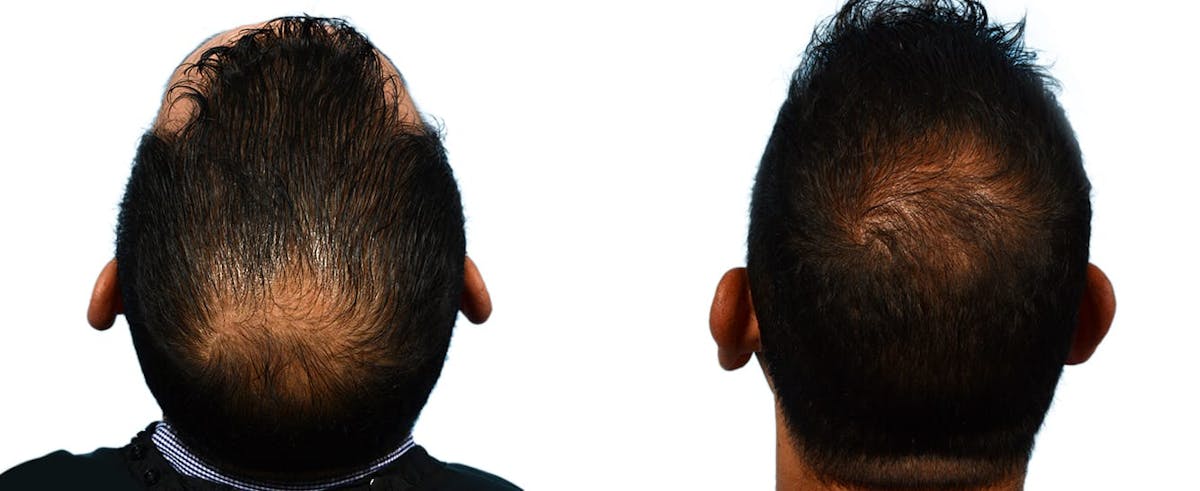 Hair Restoration Before & After Gallery - Patient 114079 - Image 2
