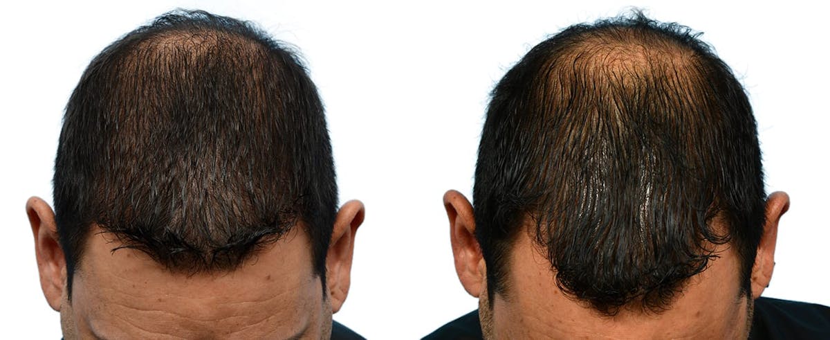FUE Hair Transplant Before & After Gallery - Patient 221591 - Image 3