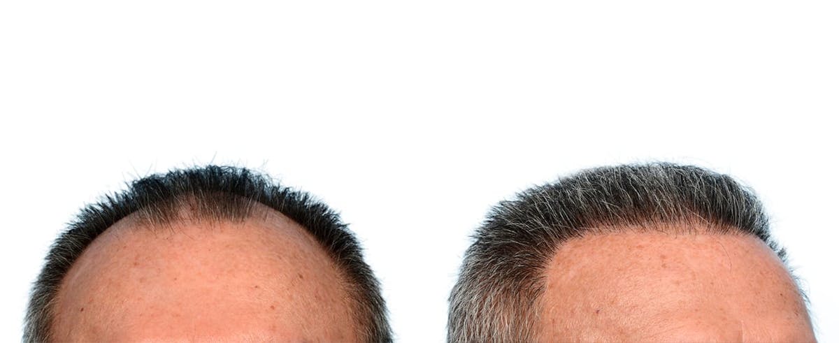 Hair Restoration Before & After Gallery - Patient 291379 - Image 2