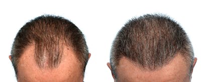 FUE Hair Transplant Before & After Gallery - Patient 147945 - Image 1