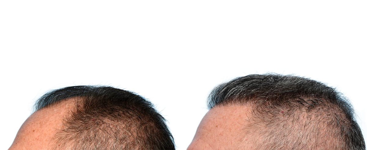 FUE Hair Transplant Before & After Gallery - Patient 147945 - Image 3