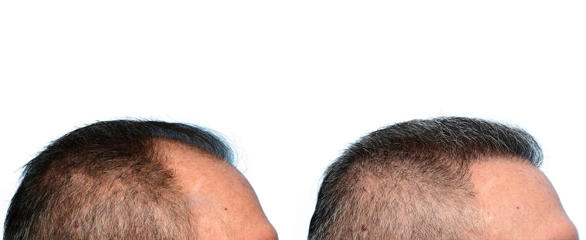 Hair Restoration Before & After Gallery - Patient 291379 - Image 4