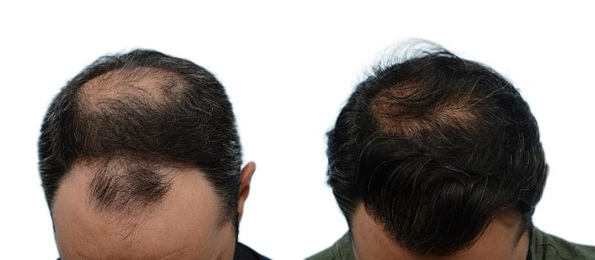 FUE Hair Transplant Before & After Gallery - Patient 149562 - Image 1