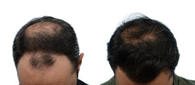 Hair Restoration Before & After Gallery - Patient 190789 - Image 1