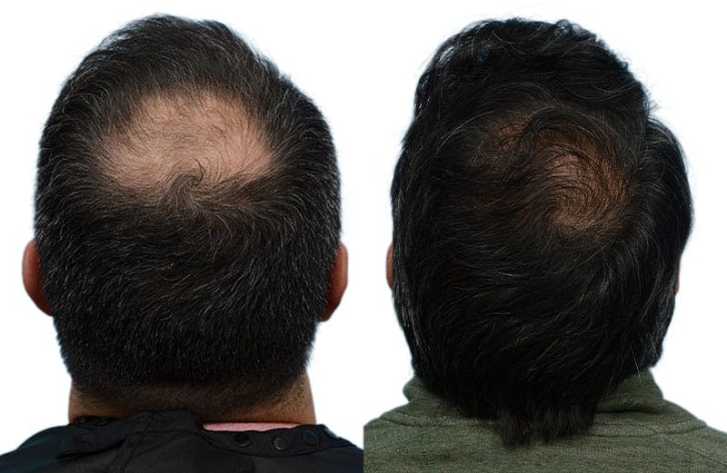 Hair Restoration  Before & After Gallery - Patient 190789 - Image 2
