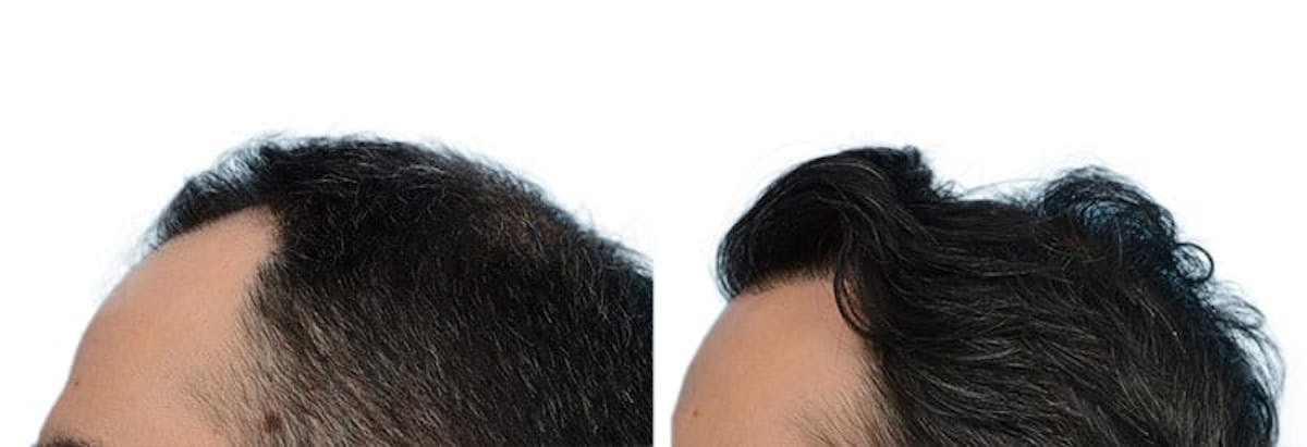 FUE Hair Transplant Before & After Gallery - Patient 149562 - Image 3
