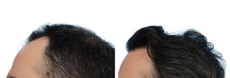 Hair Restoration  Before & After Gallery - Patient 190789 - Image 3