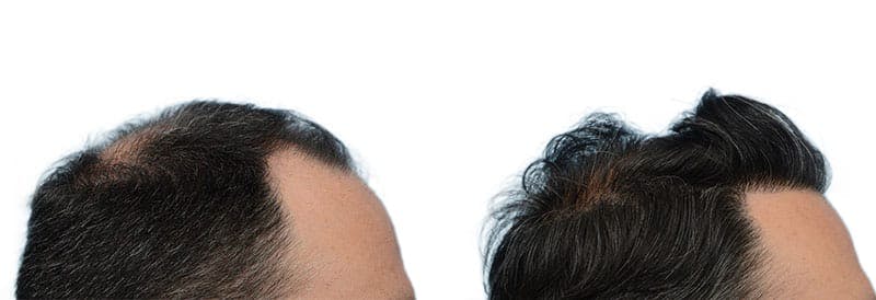 Hair Restoration  Before & After Gallery - Patient 190789 - Image 4