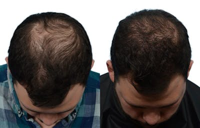 Hair Restoration Before & After Gallery - Patient 193822 - Image 1