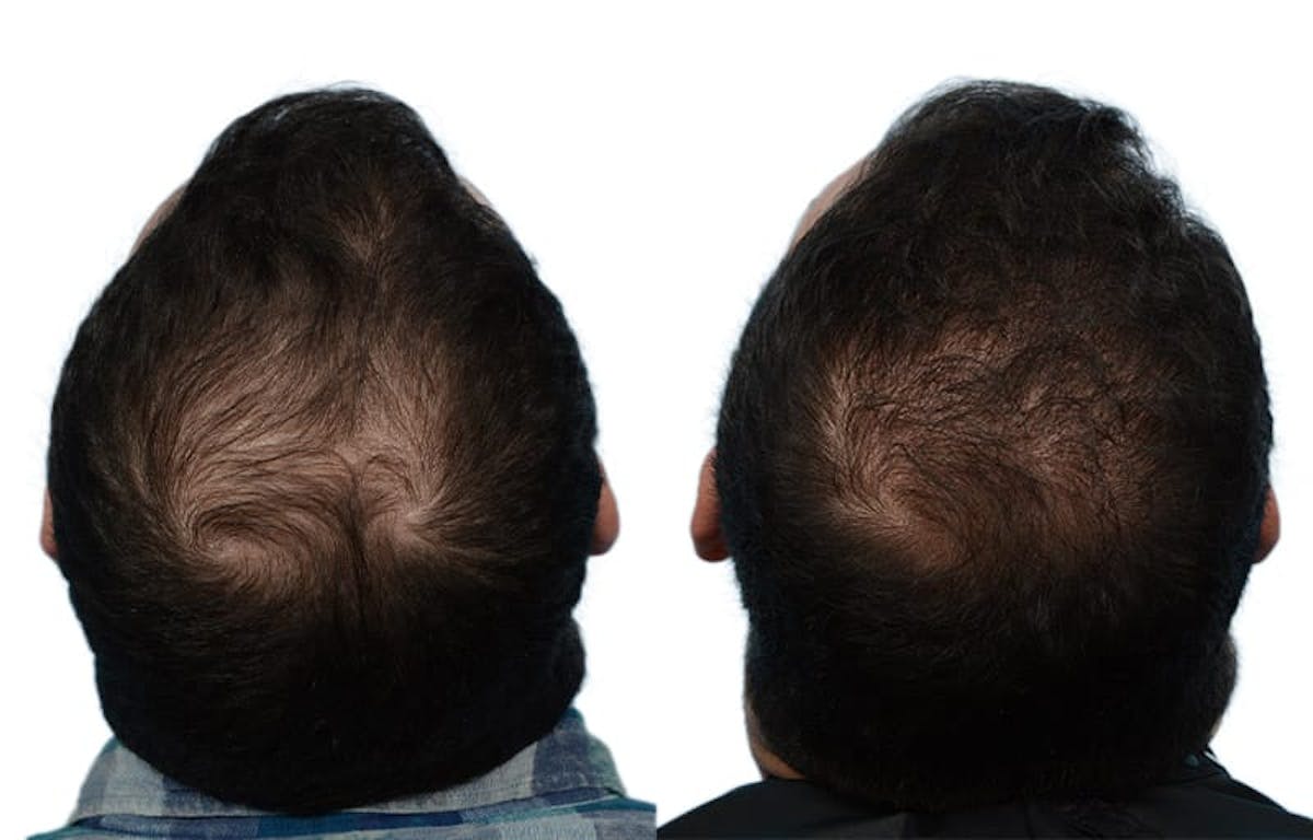 Hair Restoration Before & After Gallery - Patient 193822 - Image 2