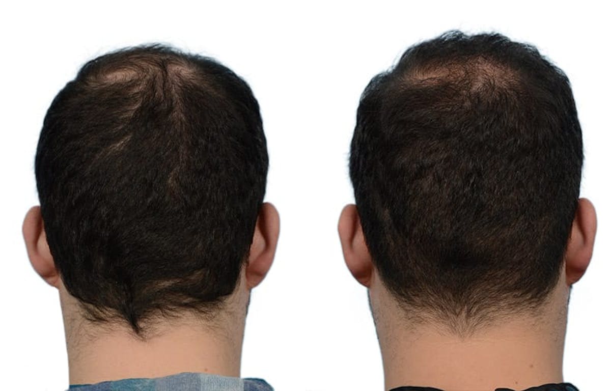 Hair Restoration Before & After Gallery - Patient 193822 - Image 3
