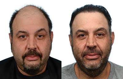 FUE Hair Transplant Before & After Gallery - Patient 220443 - Image 1