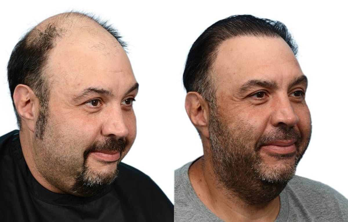 FUE Hair Transplant Before & After Gallery - Patient 220443 - Image 2