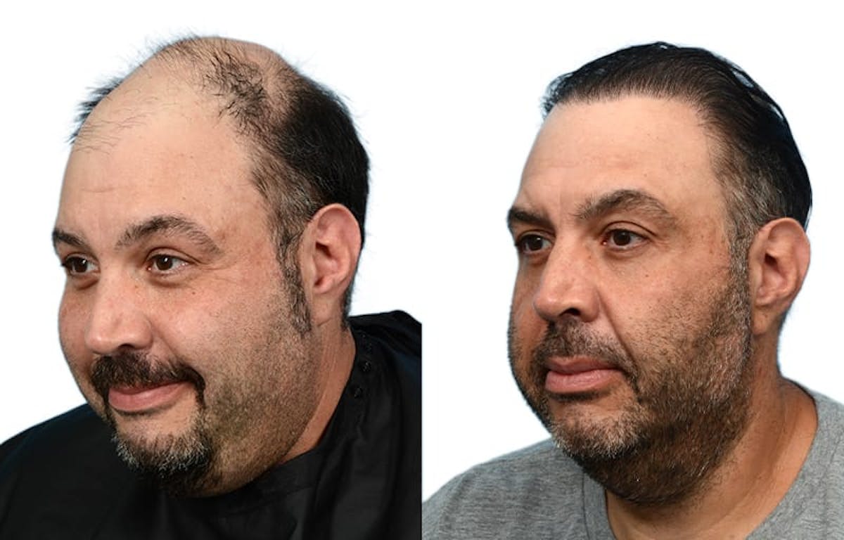 Hair Restoration Before & After Gallery - Patient 755503 - Image 3