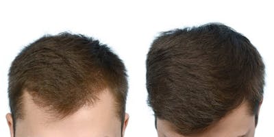 FUE Hair Transplant Before & After Gallery - Patient 107538 - Image 1