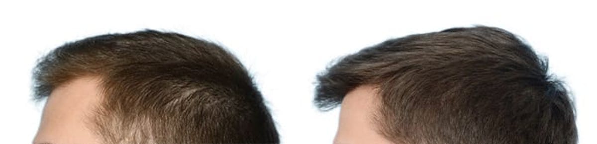 FUE Hair Transplant Before & After Gallery - Patient 107538 - Image 2