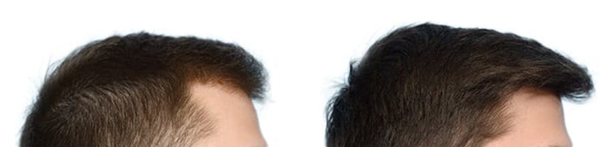 FUE Hair Transplant Before & After Gallery - Patient 107538 - Image 3