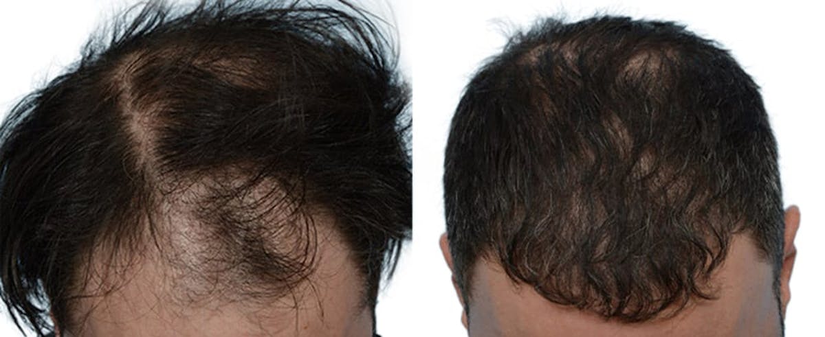 Hair Restoration Before & After Gallery - Patient 182555 - Image 1
