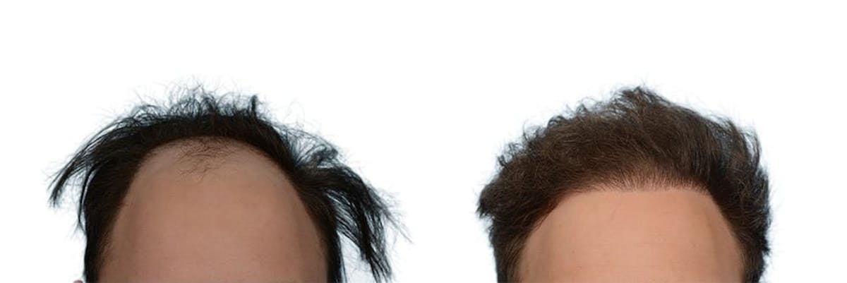FUE Hair Transplant Before & After Gallery - Patient 117873 - Image 2