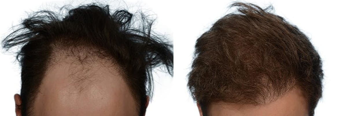 FUE Hair Transplant Before & After Gallery - Patient 117873 - Image 1