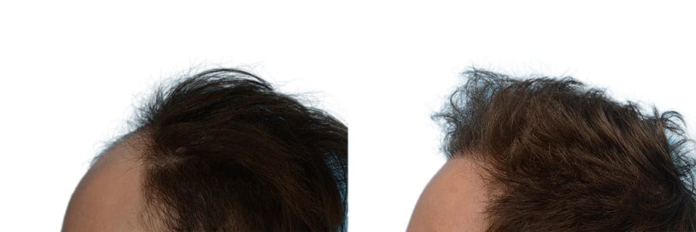 FUE Hair Transplant Before & After Gallery - Patient 117873 - Image 3