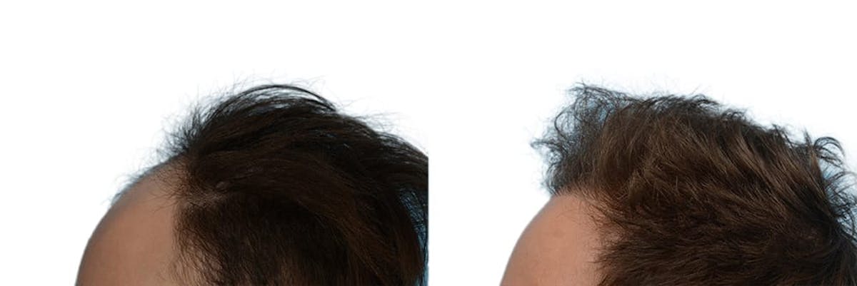 Hair Restoration Before & After Gallery - Patient 275791 - Image 3