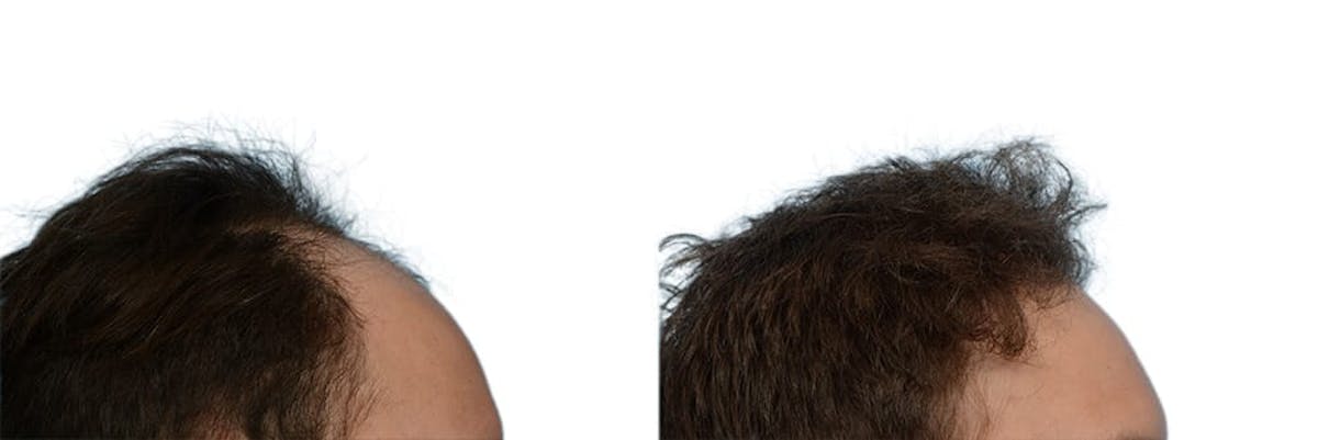 FUE Hair Transplant Before & After Gallery - Patient 117873 - Image 4