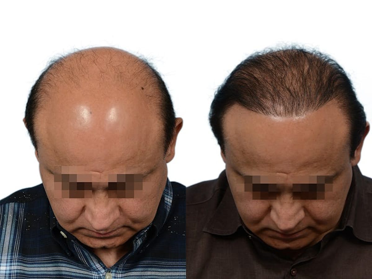 Hair Restoration Before & After Gallery - Patient 260391 - Image 1