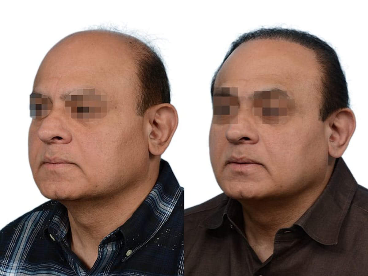 Hair Restoration Before & After Gallery - Patient 260391 - Image 2