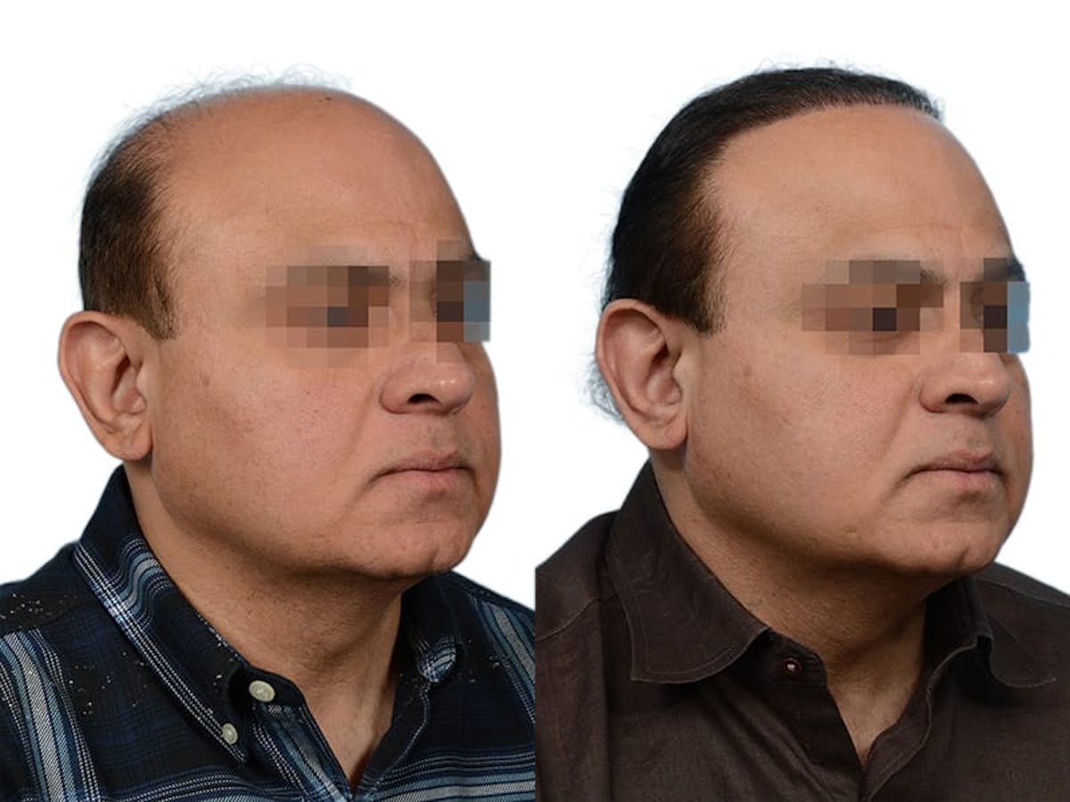 Hair Restoration Before & After Gallery - Patient 260391 - Image 3
