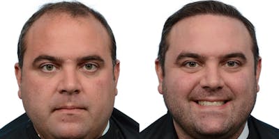 FUE Hair Transplant Before & After Gallery - Patient 256877 - Image 1