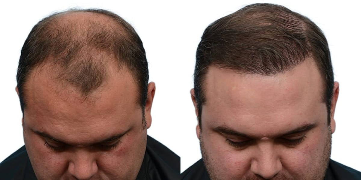 Hair Restoration Before & After Gallery - Patient 350150 - Image 2