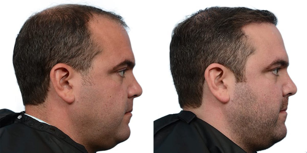 FUE Hair Transplant Before & After Gallery - Patient 256877 - Image 3