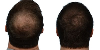 FUE Hair Transplant Before & After Gallery - Patient 384777 - Image 1