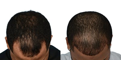 Hair Restoration Before & After Gallery - Patient 115070 - Image 1