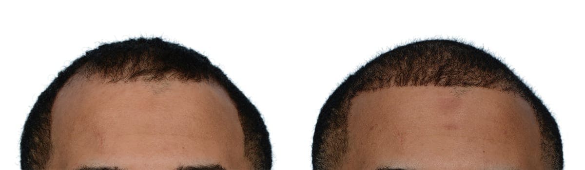 FUE Hair Transplant Before & After Gallery - Patient 254832 - Image 2