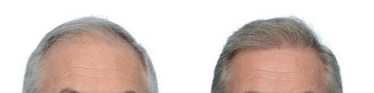 Hair Restoration Before & After Gallery - Patient 357215 - Image 1