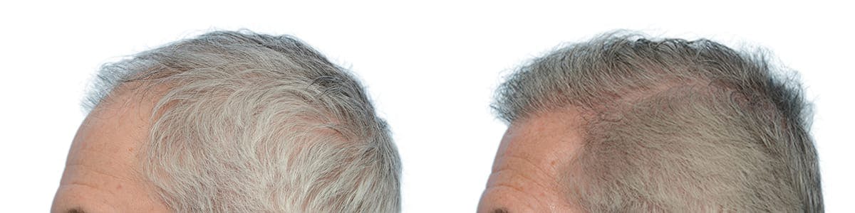 Hair Restoration Before & After Gallery - Patient 357215 - Image 2