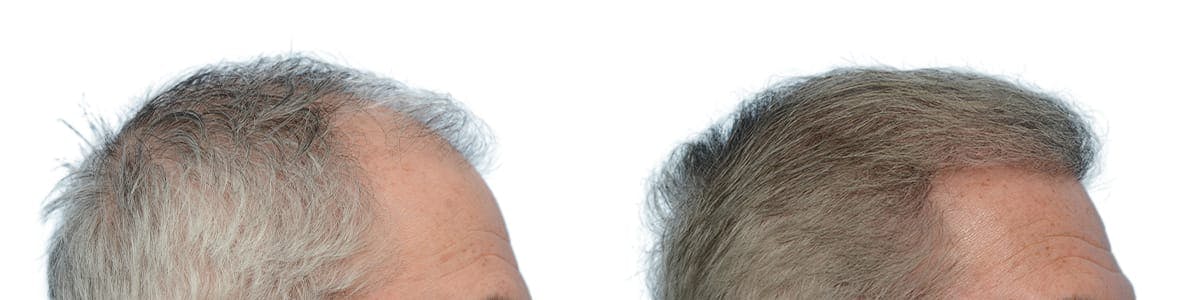 Hair Restoration Before & After Gallery - Patient 357215 - Image 3