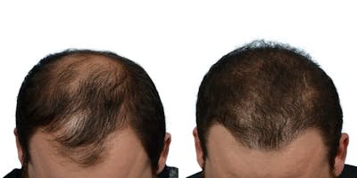 FUE Hair Transplant Before & After Gallery - Patient 116778 - Image 1