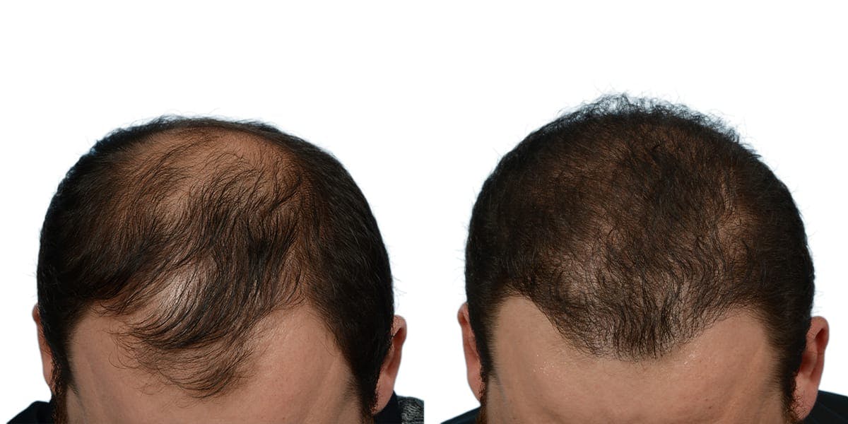 FUE Hair Transplant Before & After Gallery - Patient 116778 - Image 1